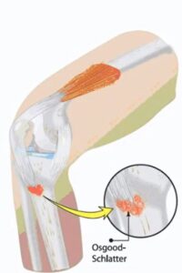 Ból kolana podczas aktywności fizycznej – objawy choroby Osgood-Schlattera u dziecka.