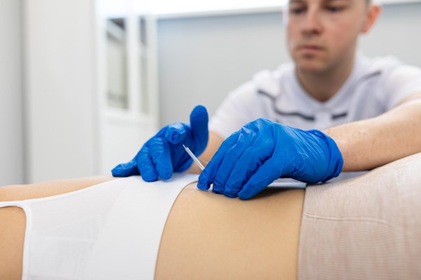 Na czym polega suche igłowanie?