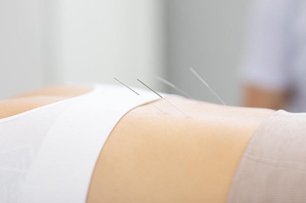 jak przebiega igloterapia