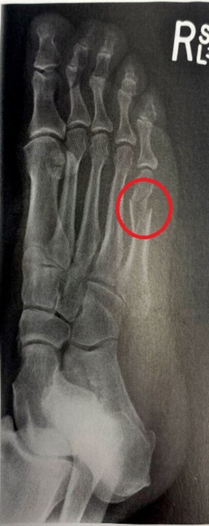 złamanie kości śródstopia 3