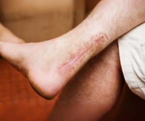 Co zrobić z blizną po operacji