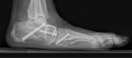 rentgen płaskostopia